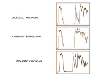 CHOROIDAL MELANOMA
CHOROIDAL HEMANGIOMA
METASTATIC CARCINOMA
 