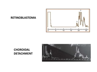 RETINOBLASTOMA
CHOROIDAL
DETACHMENT
 
