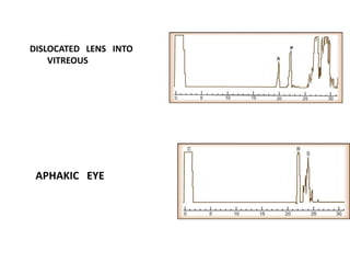 DISLOCATED LENS INTO
VITREOUS
APHAKIC EYE
 