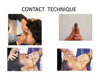 CONTACT TECHNIQUE
 