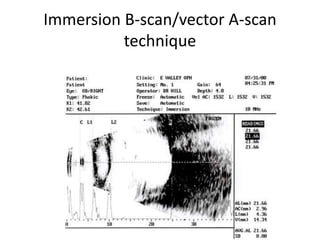 Immersion B-scan/vector A-scan
technique
 