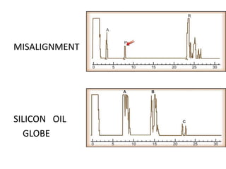 MISALIGNMENT
SILICON OIL
GLOBE
 