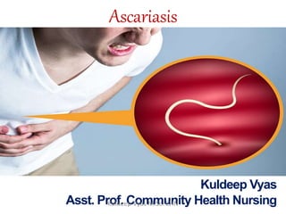 Ascariasis
Kuldeep Vyas
Asst. Prof. Community Health NursingKuldeep Vyas M.Sc. CHN 1
 