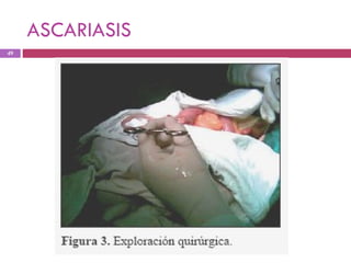 ASCARIASIS 