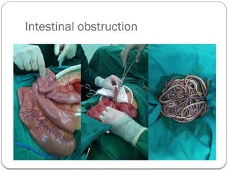 Intestinal obstruction
 