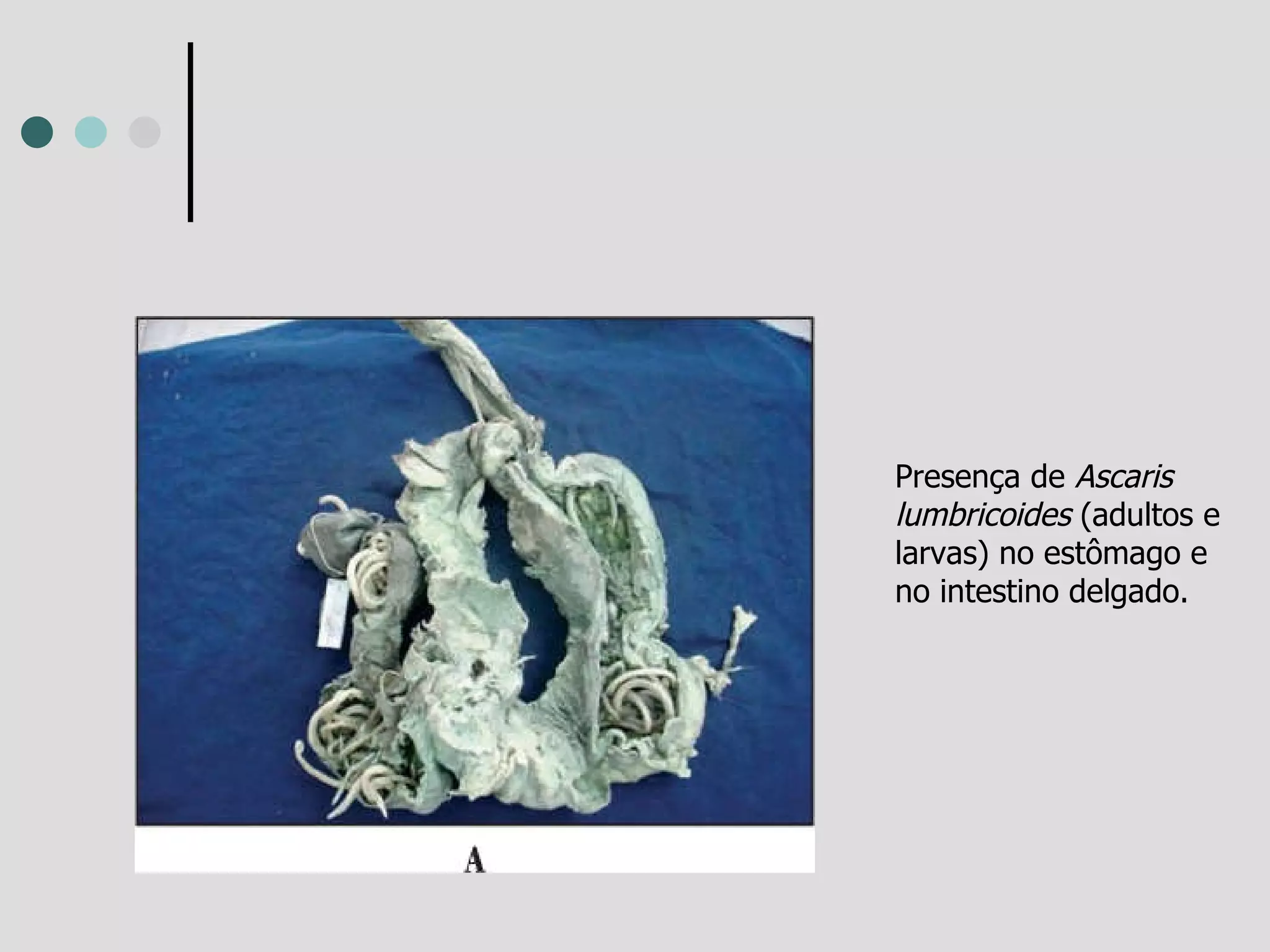 Presença de  Ascaris lumbricoides  (adultos e larvas) no estômago e no intestino delgado. 