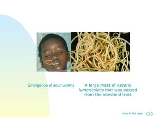 Emergence of adult worms A large mass of  Ascaris lumbricoides  that was passed from the intestinal tract 