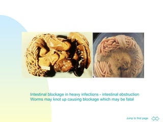 Intestinal blockage in heavy infections - intestinal obstruction  Worms may knot up causing blockage which may be fatal 