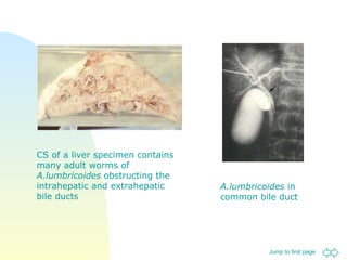CS of a liver specimen contains many adult worms of  A.lumbricoides  obstructing the intrahepatic and extrahepatic bile ducts A.lumbricoides  in common bile duct 