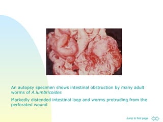 An autopsy specimen shows intestinal obstruction by many adult worms of  A.lumbricoides Markedly distended intestinal loop and worms protruding from the perforated wound 