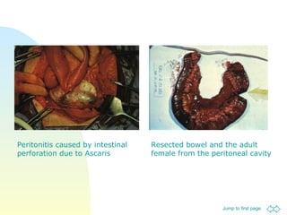 Peritonitis caused by intestinal perforation due to Ascaris Resected bowel and the adult female from the peritoneal cavity 