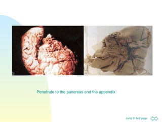 Penetrate to the pancreas and the appendix  