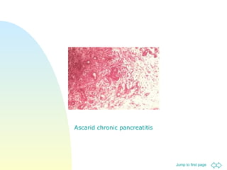 Ascarid chronic pancreatitis 