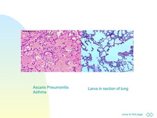 Larva in section of lung Ascaris Pneumonitis Asthma 