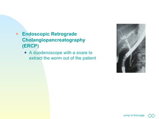 Endoscopic Retrograde Cholangiopancreatography (ERCP) A duodenoscope with a snare to extract the worm out of the patient 