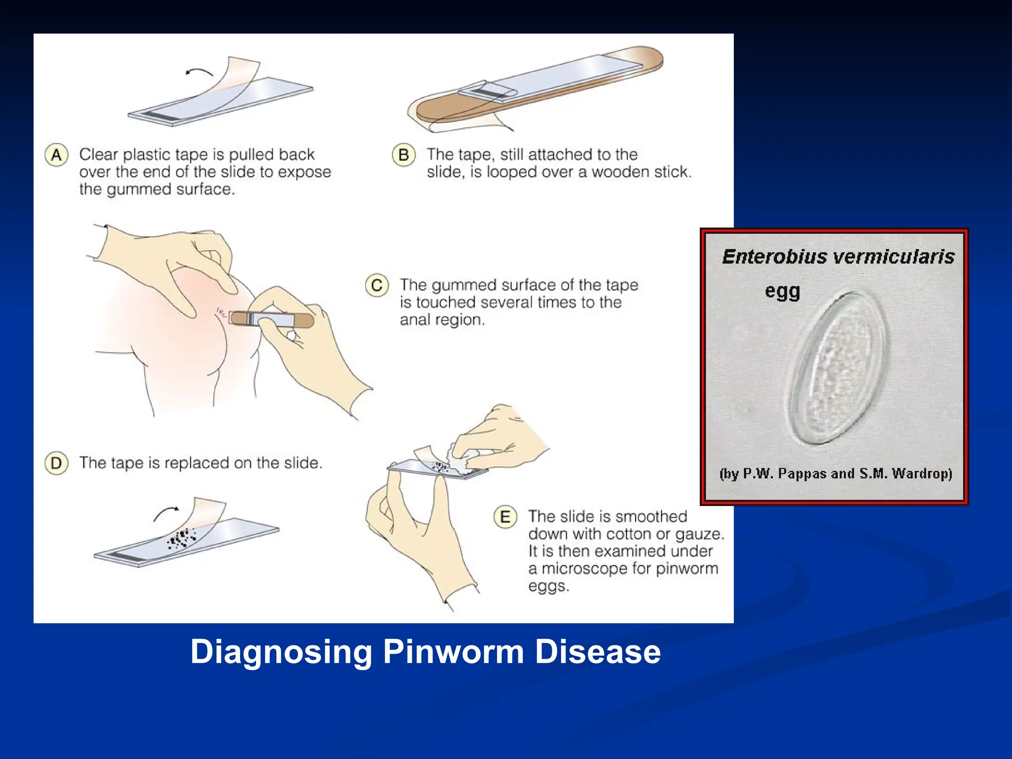 Diagnosing Pinworm Disease
 