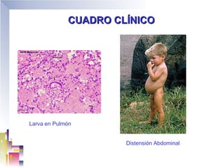 CUADRO CLÍNICO




Larva en Pulmón


                      Distensión Abdominal
 