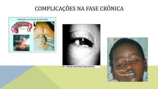 COMPLICAÇÕES NA FASE CRÔNICA
 