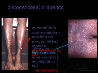 as microfilárias causam erupções e urticárias que provocam intensa coceira e  despigmentação da pele , fibrose com  hiperqueratose   atrofia epitelial e de glândulas da pele: a  oncodermatite oncocercose: a doença 