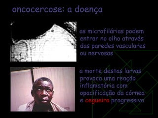oncocercose: a doença as microfilárias podem entrar no olho através das paredes vasculares ou nervosas a morte destas larvas provoca uma reação inflamatória com opacificação da córnea e  cegueira  progressiva 