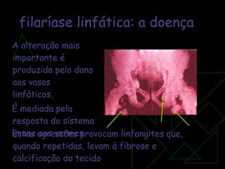 filaríase linfática:   a doença A alteração mais  importante é produzida pelo dano aos vasos  linfáticos,  É mediada pela  resposta do sistema imune aos vermes Estas agressões provocam linfangites que, quando repetidas, levam à fibrose e calcificação do tecido 