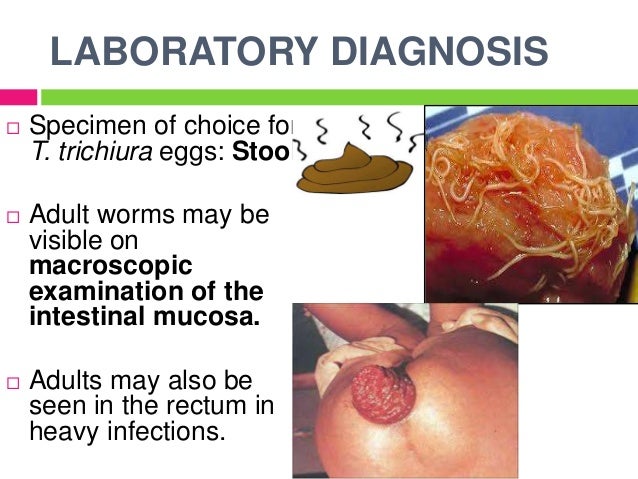 ascariasis roundworms