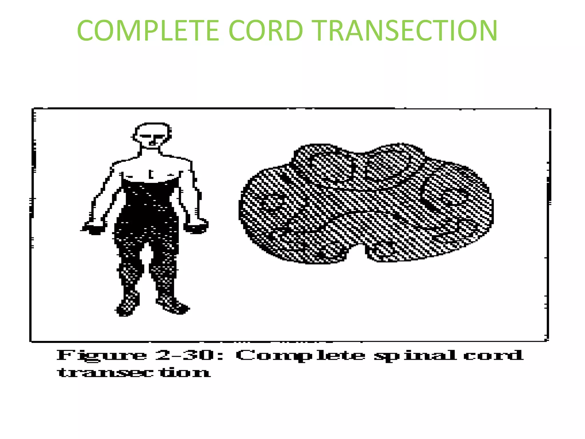 COMPLETE CORD TRANSECTION
 