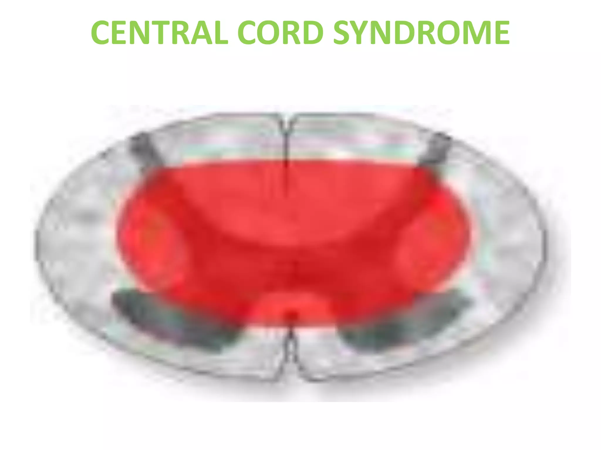 CENTRAL CORD SYNDROME
 
