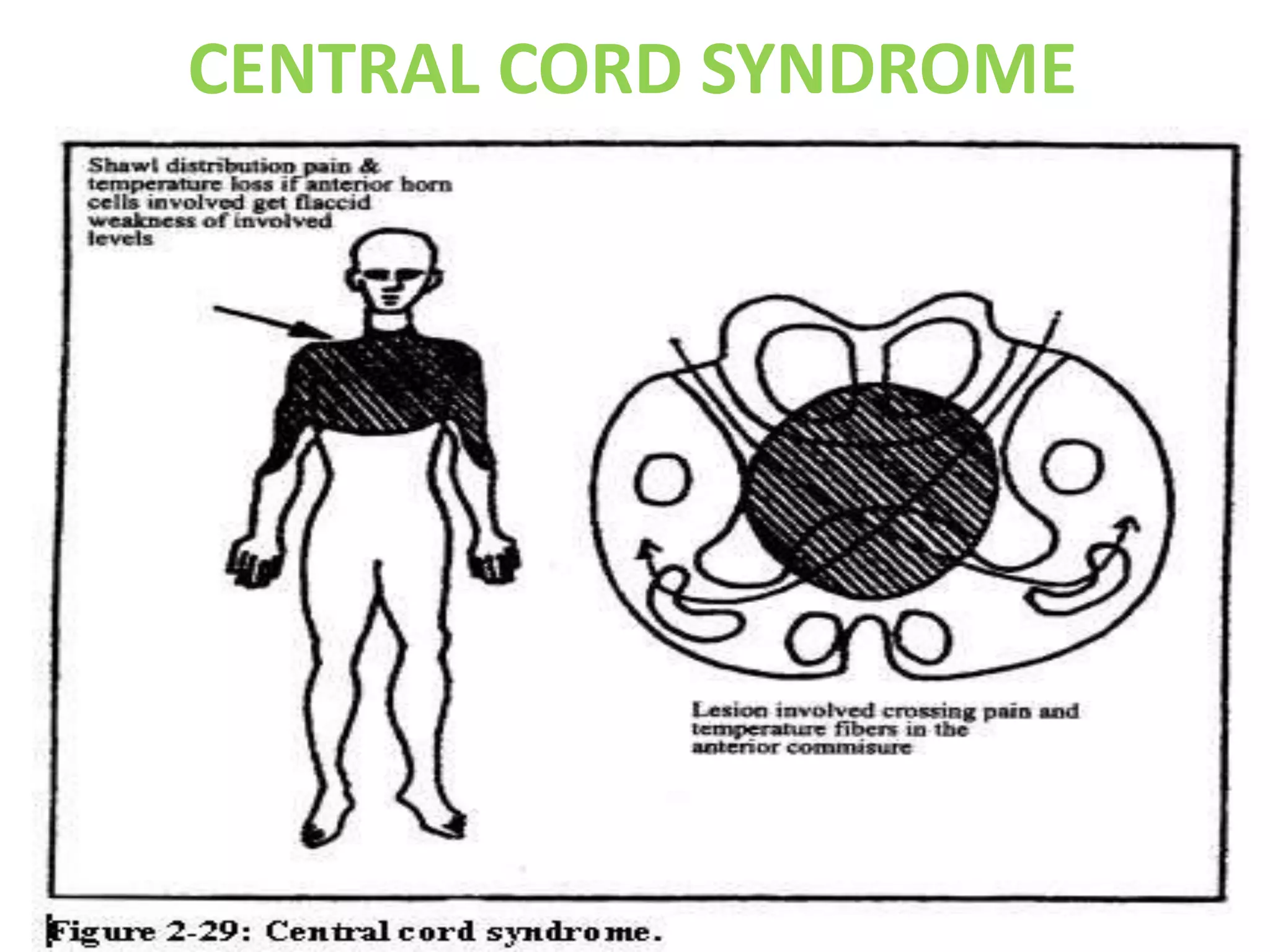 CENTRAL CORD SYNDROME
 