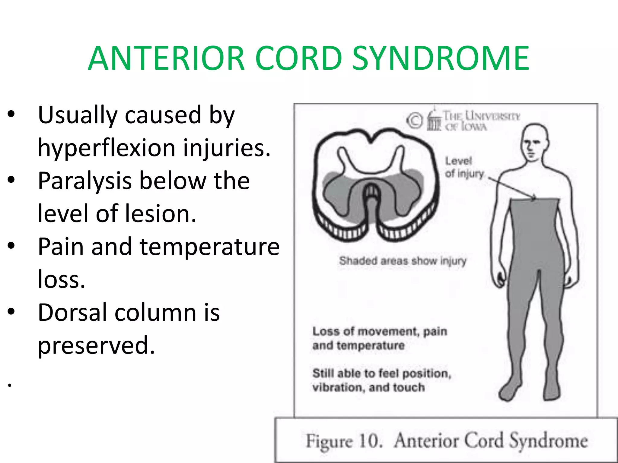 ANTERIOR CORD SYNDROME
• Usually caused by
hyperflexion injuries.
• Paralysis below the
level of lesion.
• Pain and temperature
loss.
• Dorsal column is
preserved.
.
 