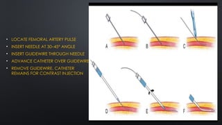 Guide Wire Injection Ascending and Translumbar aortography presentation. | PPTX