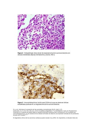 Zu y col. informaron la presencia de las anomalías cromosómicas 55,XY,+der(1:17)
(q10:q10),+2,+7,+8,+19,+20,+21,+22 en el análisis citogenético.20 La hibridación in situ con fluorescencia
multicolor en muestras de tejido fijado en parafina demostró polisomía del cromosoma 8. En el análisis por
inmunohistoquímica, en los núcleos de las células tumorales se observó una expresión elevada de los productos
del gen p53 mutado.21,22

El diagnóstico clínico de los sarcomas cardíacos puede resultar muy difícil. Es importante un elevado índice de
 