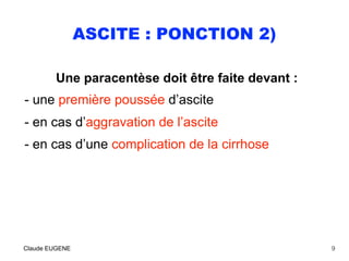 ASCITE : PONCTION 2)
Une paracentèse doit être faite devant :
- une première poussée d’ascite
- en cas d’aggravation de l’...
