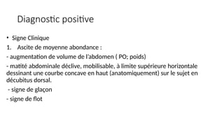 Diagnostic positive
• Signe Clinique
1. Ascite de moyenne abondance :
- augmentation de volume de l’abdomen ( PO; poids)
- matité abdominale déclive, mobilisable, à limite supérieure horizontale
dessinant une courbe concave en haut (anatomiquement) sur le sujet en
décubitus dorsal.
- signe de glaçon
- signe de flot
 