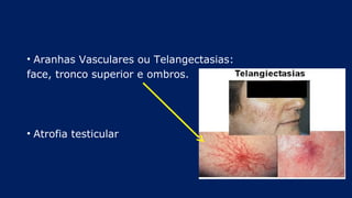 • Aranhas Vasculares ou Telangectasias:
face, tronco superior e ombros.
• Atrofia testicular
 