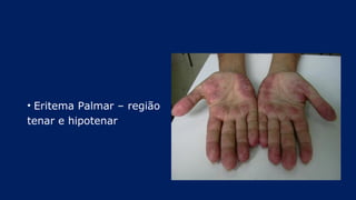 • Eritema Palmar – região
tenar e hipotenar
 