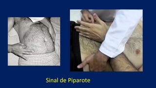 Sinal de Piparote
 