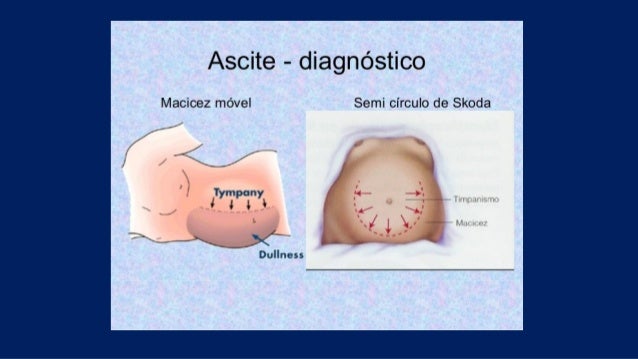 Ascite