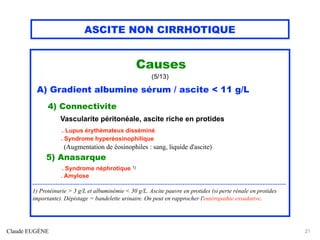 ASCITE NON CIRRHOTIQUE
Causes
(5/13)
A) Gradient albumine sérum / ascite < 11 g/L
4) Connectivite
Vascularite péritonéale, ascite riche en protides
. Lupus érythémateux disséminé
. Syndrome hyperéosinophilique
(Augmentation de éosinophiles : sang, liquide d'ascite)
5) Anasarque
. Syndrome néphrotique 1)
. Amylose
........................................................................................................................................................
1) Protéinurie > 3 g/L et albuminémie < 30 g/L. Ascite pauvre en protides (si perte rénale en protides
importante). Dépistage = bandelette urinaire. On peut en rapprocher l'entéropathie exsudative.
Claude EUGÈNE 21
 