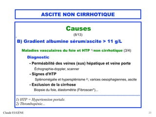 ASCITE NON CIRRHOTIQUE
Causes
(8/13)
h
B) Gradient albumine sérum/ascite > 11 g/L
Maladies vasculaires du foie et HTP 1) non cirrhotique (3/4)
Diagnostic
- Perméabilité des veines (sus) hépatique et veine porte
Échographie-doppler, scanner
- Signes d'HTP
Splénomégalie et hypersplénisme 2), varices oesophagiennes, ascite
- Exclusion de la cirrhose
Biopsie du foie, élastométrie (Fibroscan*)...
.................................................................................................................................................................
1) HTP = Hypertension portale.
2) Thrombopénie...
Claude EUGÈNE 25
 