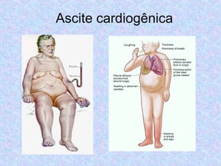 Ascite cardiogênica 
 