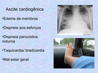 Ascite cardiogênica 
•Edema de membros 
•Dispneia aos esforços 
•Dispneia paroxística 
noturna 
•Taquicardia/ bradicardia 
•Mal estar geral 
 