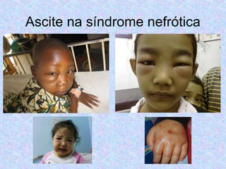 Ascite na síndrome nefrótica 
 