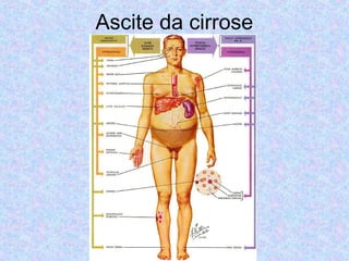 Ascite da cirrose 
 