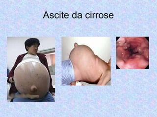 Ascite da cirrose 
 