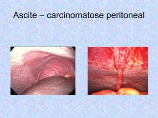 Ascite – carcinomatose peritoneal 
 