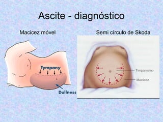 Ascite - diagnóstico 
Macicez móvel Semi círculo de Skoda 
 