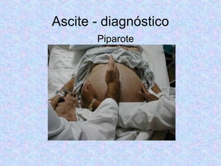 Ascite - diagnóstico 
Piparote 
 