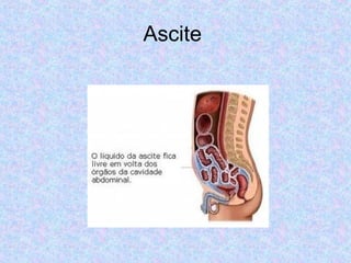 Ascite 
 