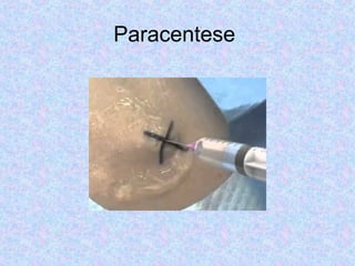 Paracentese 
 